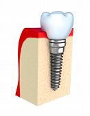 image of embed  - Dental implant in jaw bone isolated over white - JPG 
