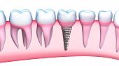 stock photo of pressure  - Dental Implant detailed view - JPG 