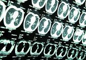 stock photo of neurology  - MRI of human brain - JPG 