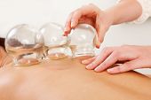 picture of globe  - Detail of an acupuncture therapist removing a glass globe in a fire cupping procedure - JPG 